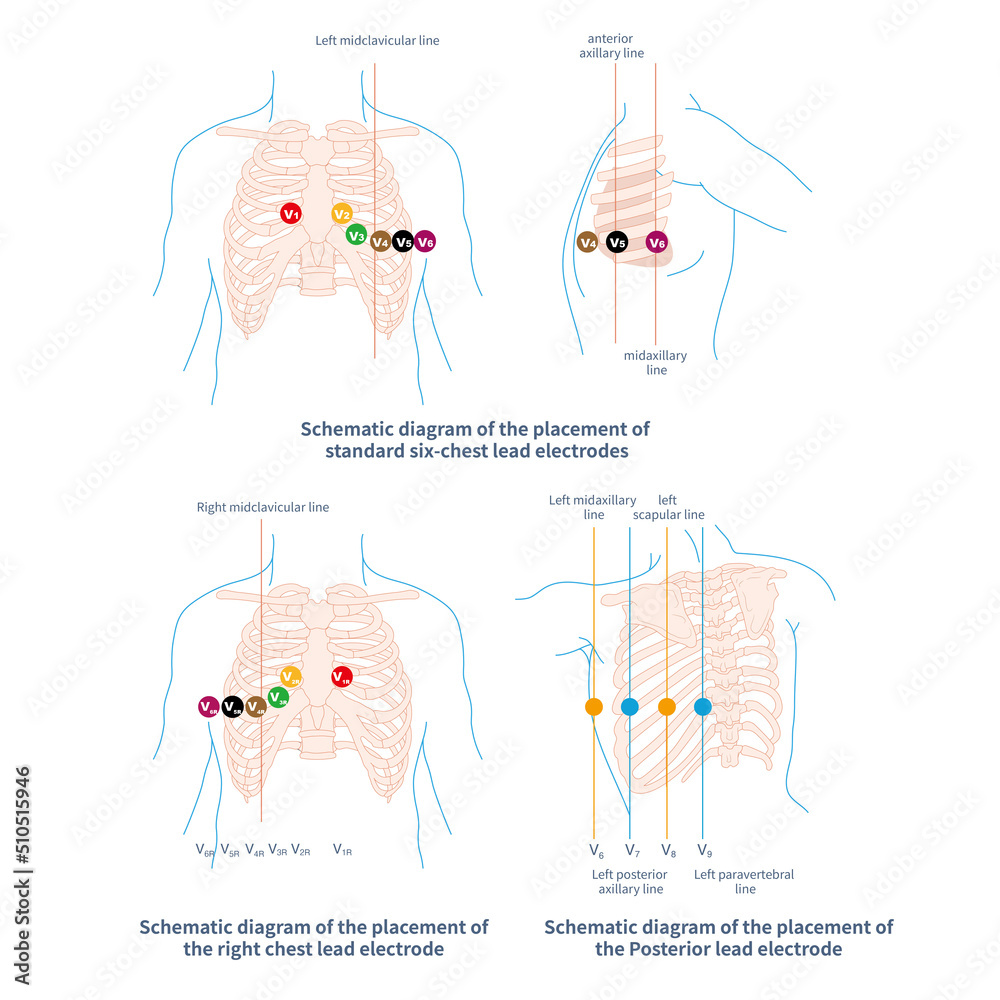 The chest electrode of ECG includes conventional chest lead, posterior