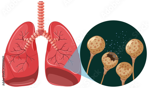 The mold spores grow in human lungs