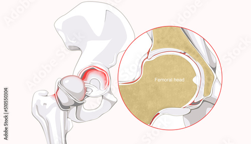 Hip Labral Tear photo