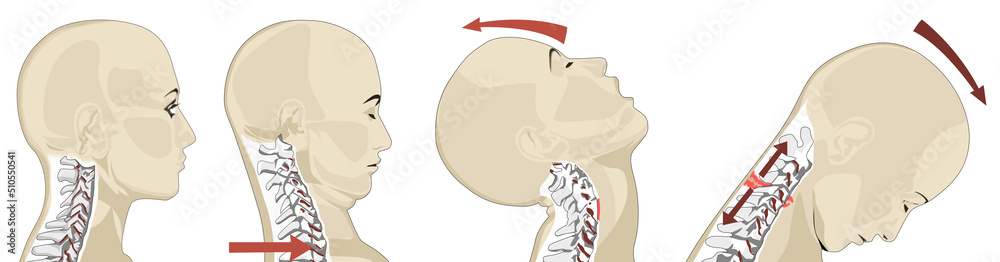 Εκτύπωση καμβά Whiplash Injury