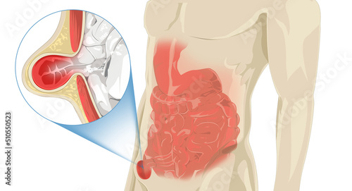 Stomach Pain Hernia