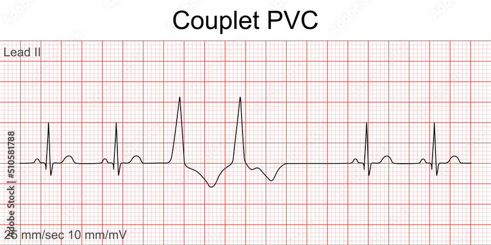 Vettoriale Stock Electrocardiogram show Couplet Premature Ventricular  Contraction (PVC) pattern ,Heart beat ,ECG ,EKG interpretation ,Vital sign  ,Life line ,Medical healthcare symbol. | Adobe Stock