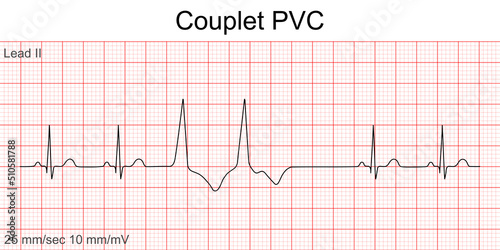 Electrocardiogram show Couplet Premature Ventricular Contraction (PVC) pattern ,Heart beat ,ECG ,EKG interpretation ,Vital sign ,Life line ,Medical healthcare symbol. photo