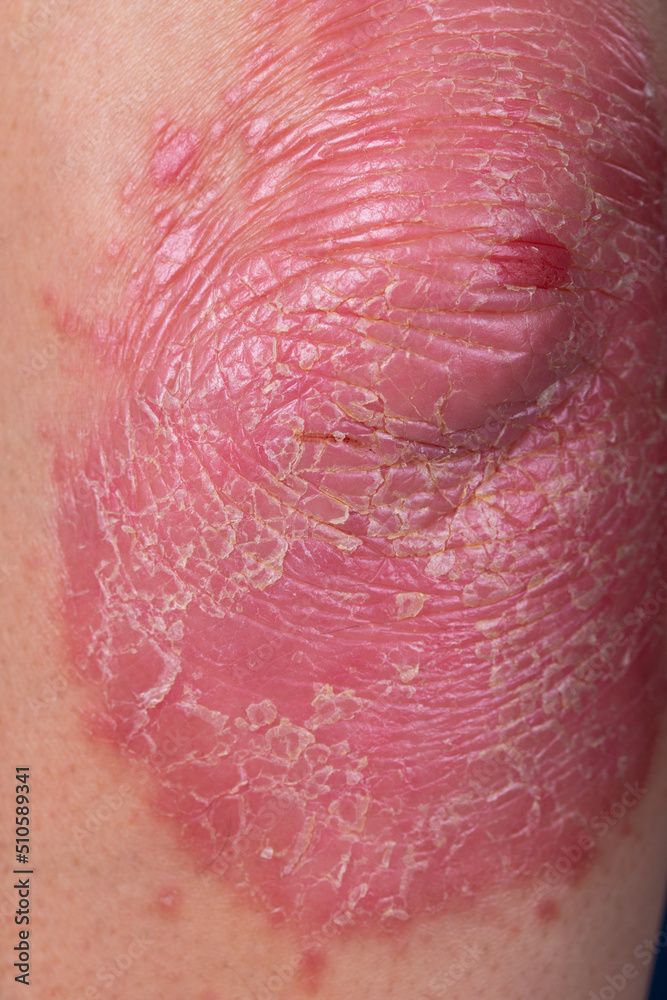 Fototapeta premium Unrecognizable man feel bad on skin disease called psoriasis. Large red, inflamed, rash on elbows