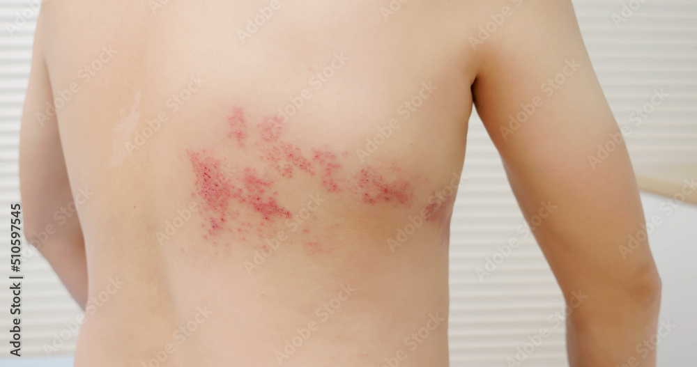 man with shingles disease