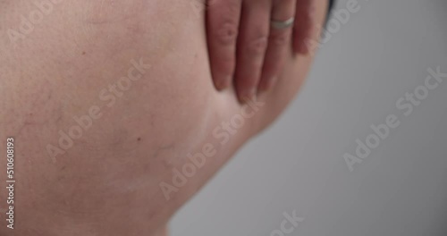 Close up slow motion, fat woman rubbing hands on skin checking for cellulite stretch marks photo
