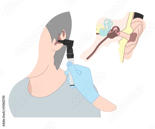 Acute Otitis Media air filled space eardrum treat pain fluid tube pus bacteria virus nasal cold flu drain swollen mastoid prevent diagnostic exam canal tool ENT Nose otalgia vertigo BPPV head wax test