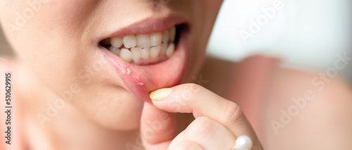 Fototapeta Naklejka Na Ścianę i Meble -  Close - up on the lip with aphthous stomatitis