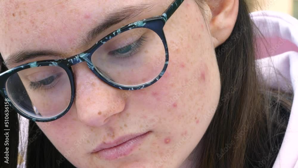 Young girl with glasses and the face covered in acne looks down, feeling shame. Young girl with glasses and the face covered in acne looks down, feeling shame.