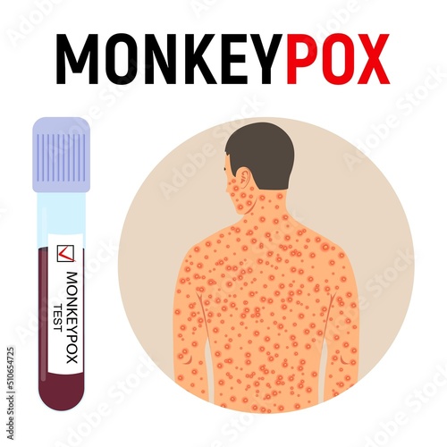 Monkeypox pandemic. A test tube with blood for a test and a man with a rash on his body is sick with smallpox. Disease symptoms. Vector illustration.
