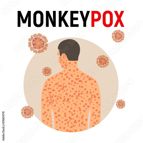Man sick with monkey smallpox in flat style isolated on white background. Background with monkey pox virus. Vector illustration.