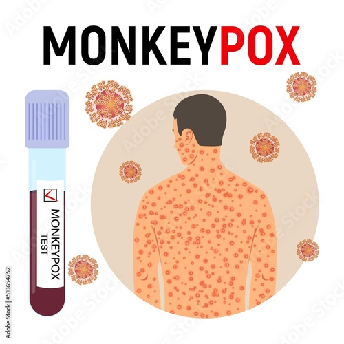 Monkeypox pandemic poster. Smallpox man, test tube with blood with a positive test and virus cells. Viral disease. Vector illustration.