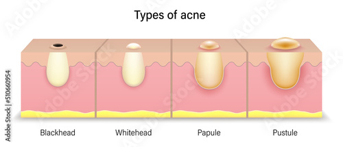 Types of acne. Human skin acne. Blackhead, Whitehead, Papule and Pustule. Vector for cosmetic advertisements. photo