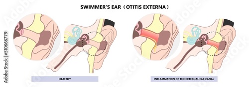 acute otitis of the inner with Swimmer's ear canal wax swelling photo