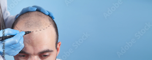 Patient suffering from hair loss in consultation with a doctor. Space for your text