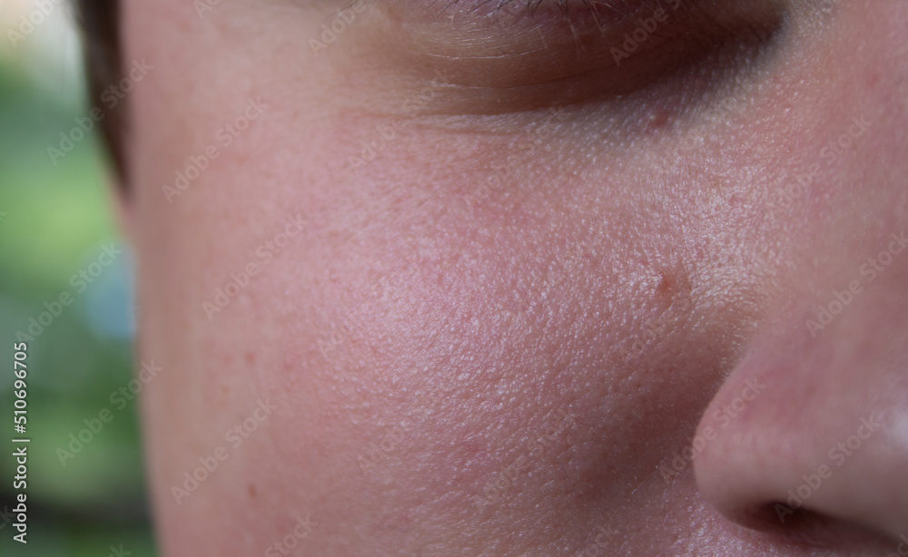 Skin texture with enlarged pores and red rashes. Environmental impact on sensitive skin concept. Skin texture with enlarged pores and red rashes. Environmental impact on sensitive skin concept.