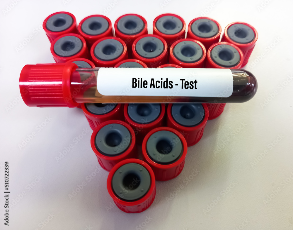 Blood sample for Bile Acids test to diagnose hepatobiliary diseases and