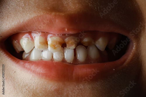 Close up milk teeth of child. 