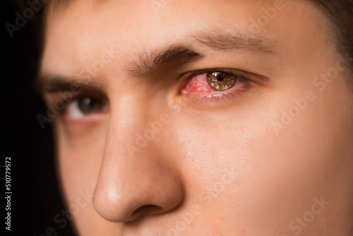 Close up of one annoyed red blood eye of male affected by conjunctivitis or after flu, cold or allergy. Concept of health, disease and treatment. Copy space for advertisement. With place for text.