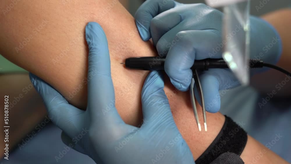 Electrolysis epilation hands hair removal. Depilation and beauty concept. The doctor works in a cosmetic medical office. hair removal Electrolysis epilation hands hair removal. Depilation and beauty concept. The doctor works in a cosmetic medical office. hair removal