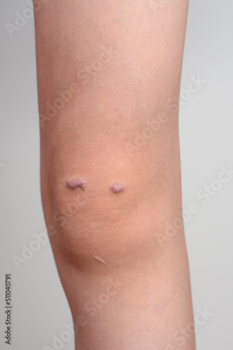 Knee of a girl with keloid scar