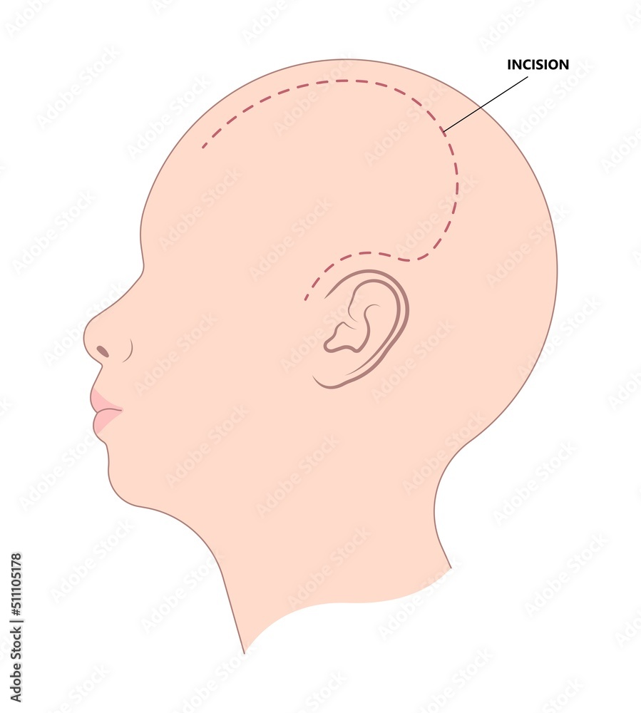 surgical to repair the skull bone with the metal mesh the procedure in medical