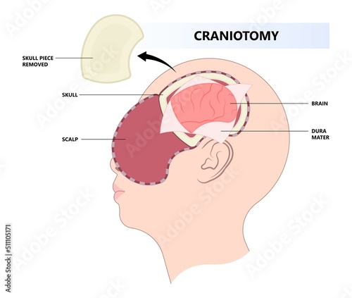 surgical to repair the skull bone with the metal mesh the procedure in medical