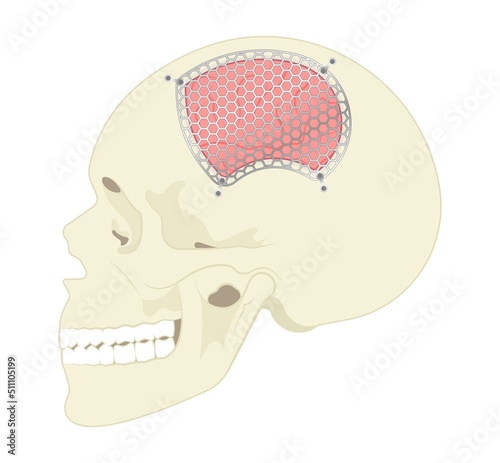 surgical to repair the skull bone with the metal mesh the procedure in medical