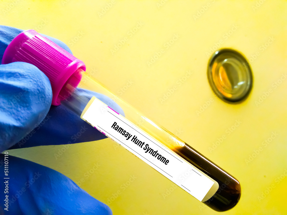 Ramsay Hunt syndrome blood sample test at medical laboratory. Which is