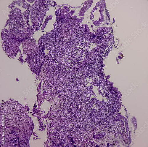 Terminal ileum(biopsy): Chronic nonspecific ileitis or inflammation of ileum, show ileal mucosa, lymphocytes,histiocytes,plasma cell, caused by Crohn's disease, inflammatory bowel disease (IBD).