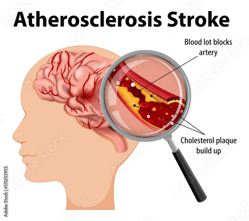 Human anatomy with atherosclerosis stroke