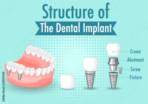 Infographic of human in structure of the dental implant