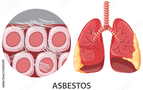 Asbestosis on human lungs