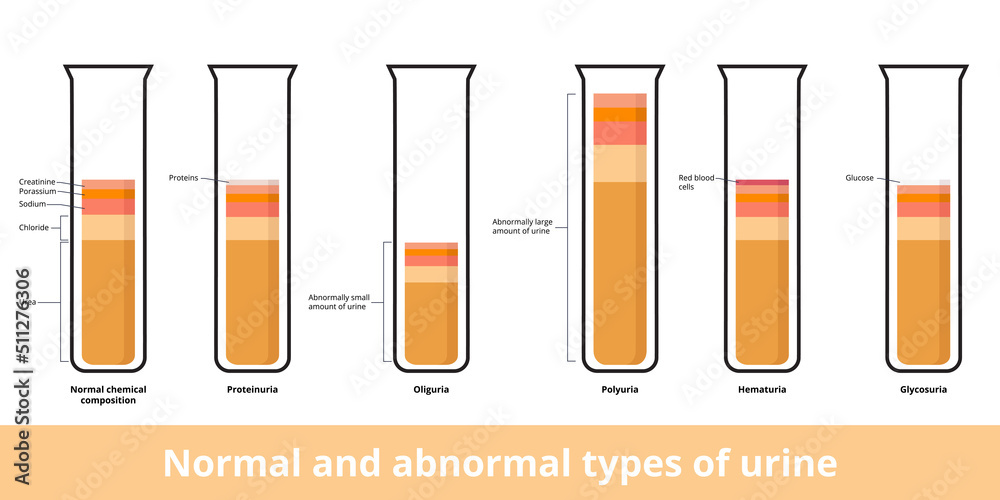 Normal сhemical сomposition of urine and its abnormal types. Common