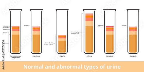 Normal сhemical сomposition of urine and its abnormal types. Common types of abnormal urine include proteinuria, oliguria, hematuria, and glycosuria. photo