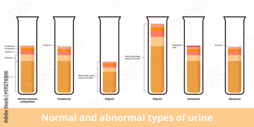 Normal сhemical сomposition of urine and its abnormal types. Common types of abnormal urine include proteinuria, oliguria, hematuria, and glycosuria.