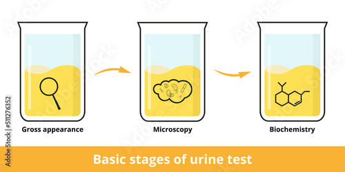 Basic stages of urine test. Urinalysis can include a visual exam (gross appearance), and a microscopic and chemistry exam (microscopy) to look for bacteria, blood cells, protein, glucose