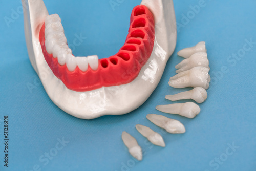 Teeth implant and crown installation process parts isolated on a blue background. Medically accurate 3D model. 