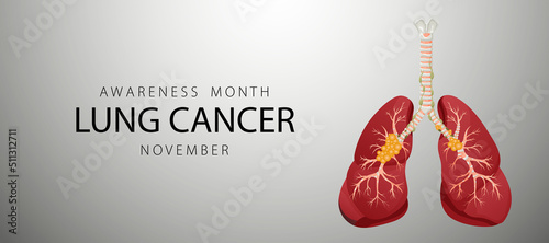 Banner informing about lung cancer. Design template for websites, magazines. Vector illustration cartoon style.