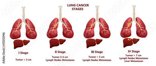 Lung cancer stages. Concept diseases human internal organs. Cartoon style, vector illustration.