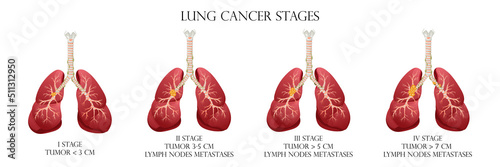 Lung cancer stages. Concept diseases human internal organs. Cartoon style, vector illustration.