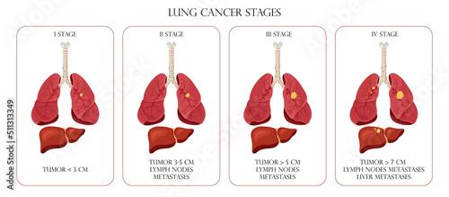 Lung cancer stages. Concept diseases human internal organs. Cartoon style, vector illustration.