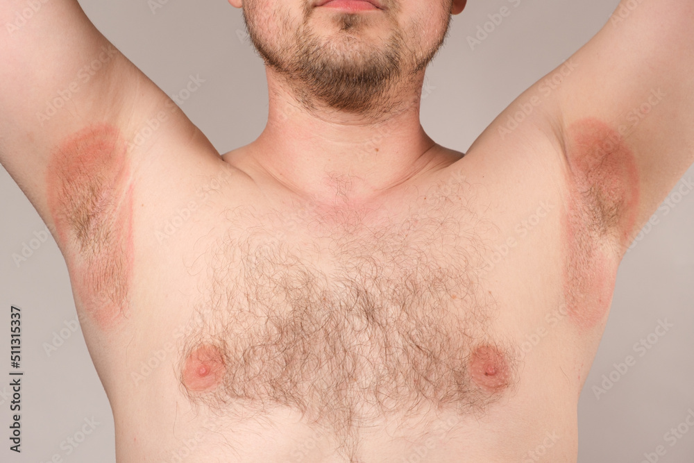 Redness of the armpits in a man - inflammation or prickly heat, red spots of the armpits.