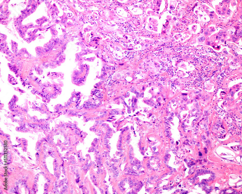 Ovarian mucinous cystadenocarcinoma photo