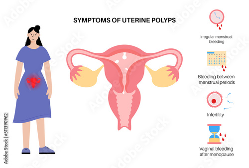 Uterus Polyps Disease