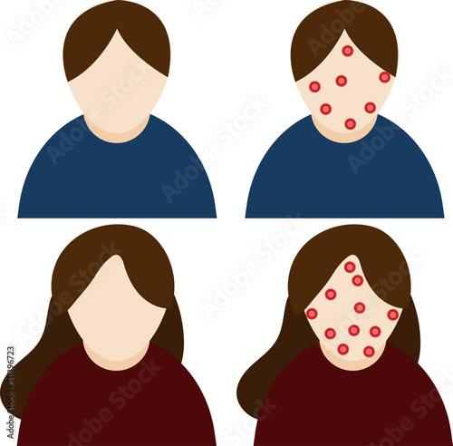 Monkeypox virus genus rash spots body skin Scabs zoonoses sick Transmission outbreak rats mice life cycle
