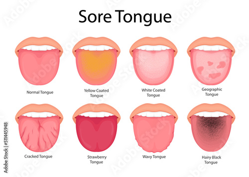 Illustration of tongue symptoms and health. medical illustration.