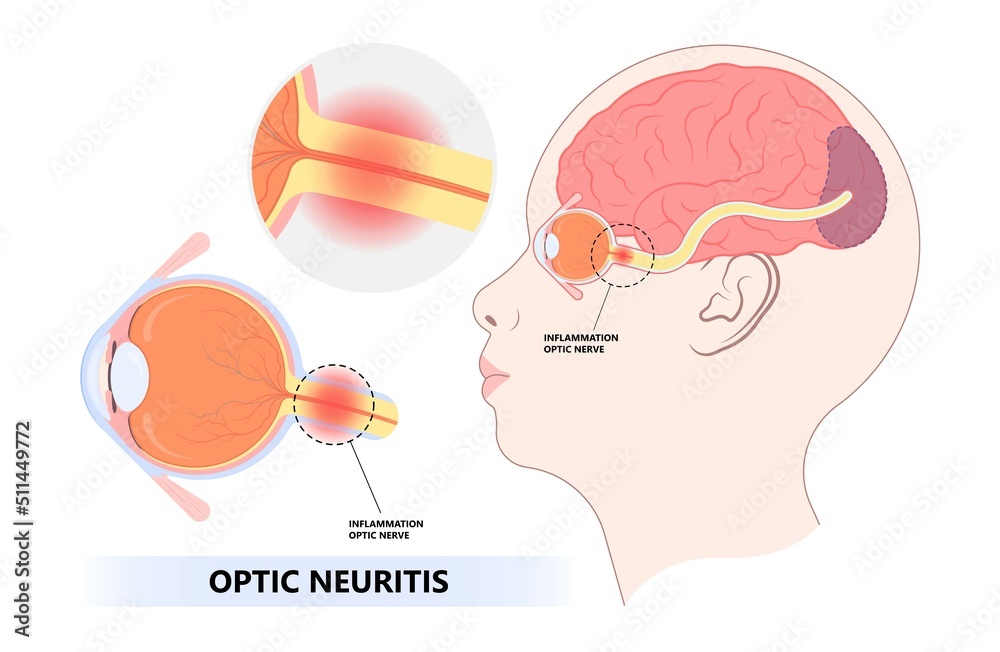 Vision loss and visual field eye disc swollen pain retina Demyelination