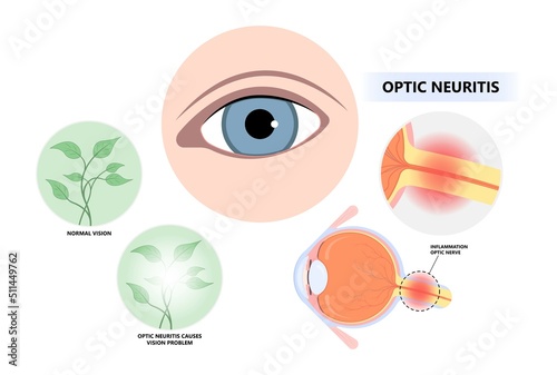 Vision loss and visual field eye disc swollen pain retina Demyelination viral Tumor cancer blind with lupus blurring spot light infectious antibody photo