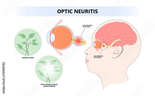 Vision loss and visual field eye disc swollen pain retina Demyelination viral Tumor cancer blind with lupus blurring spot light infectious antibody